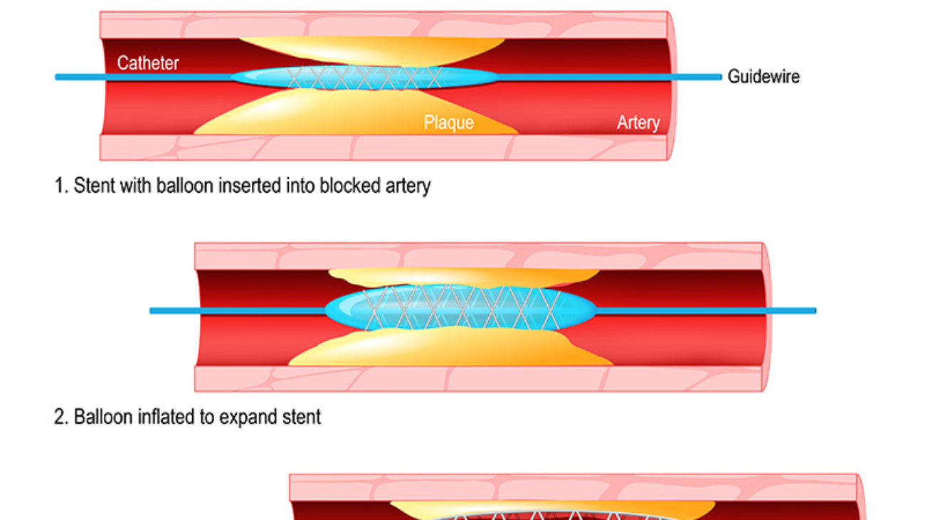 PRIMARY ANGIOPLASTY Drkiranlakkireddy