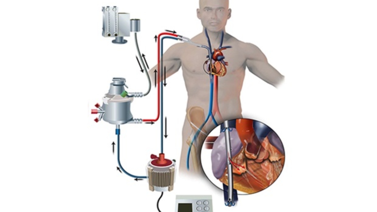 ECMO life support system providing cardiac and respiratory support.