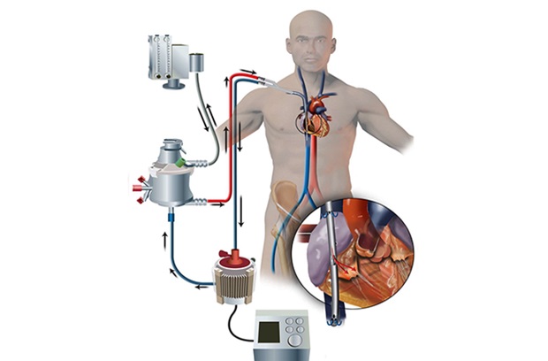 ECMO life support system providing cardiac and respiratory support.