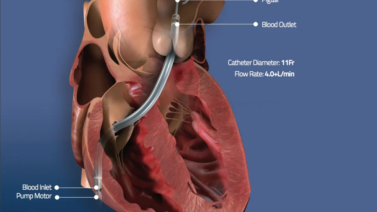 IMPELLA Dr kiran Lakkireddy