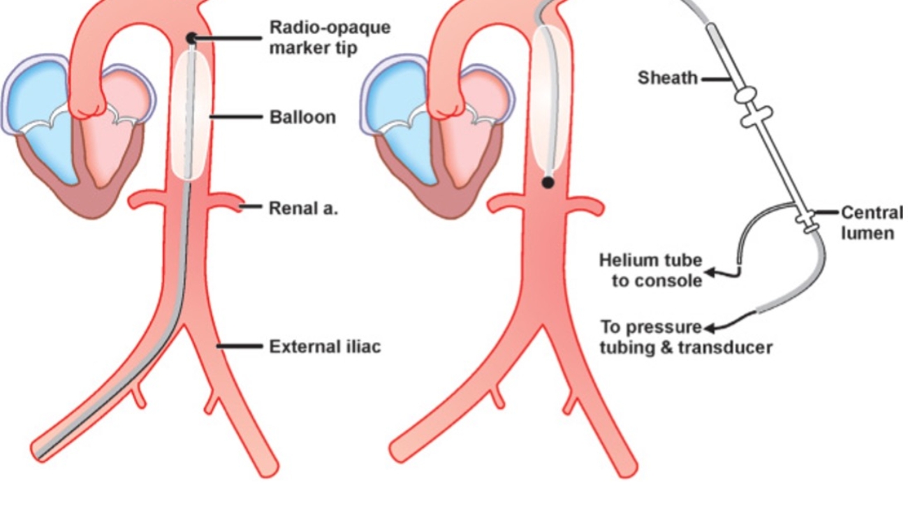 Intra-aortic Balloon Pump