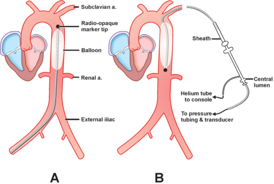 Intra-aortic Balloon Pump