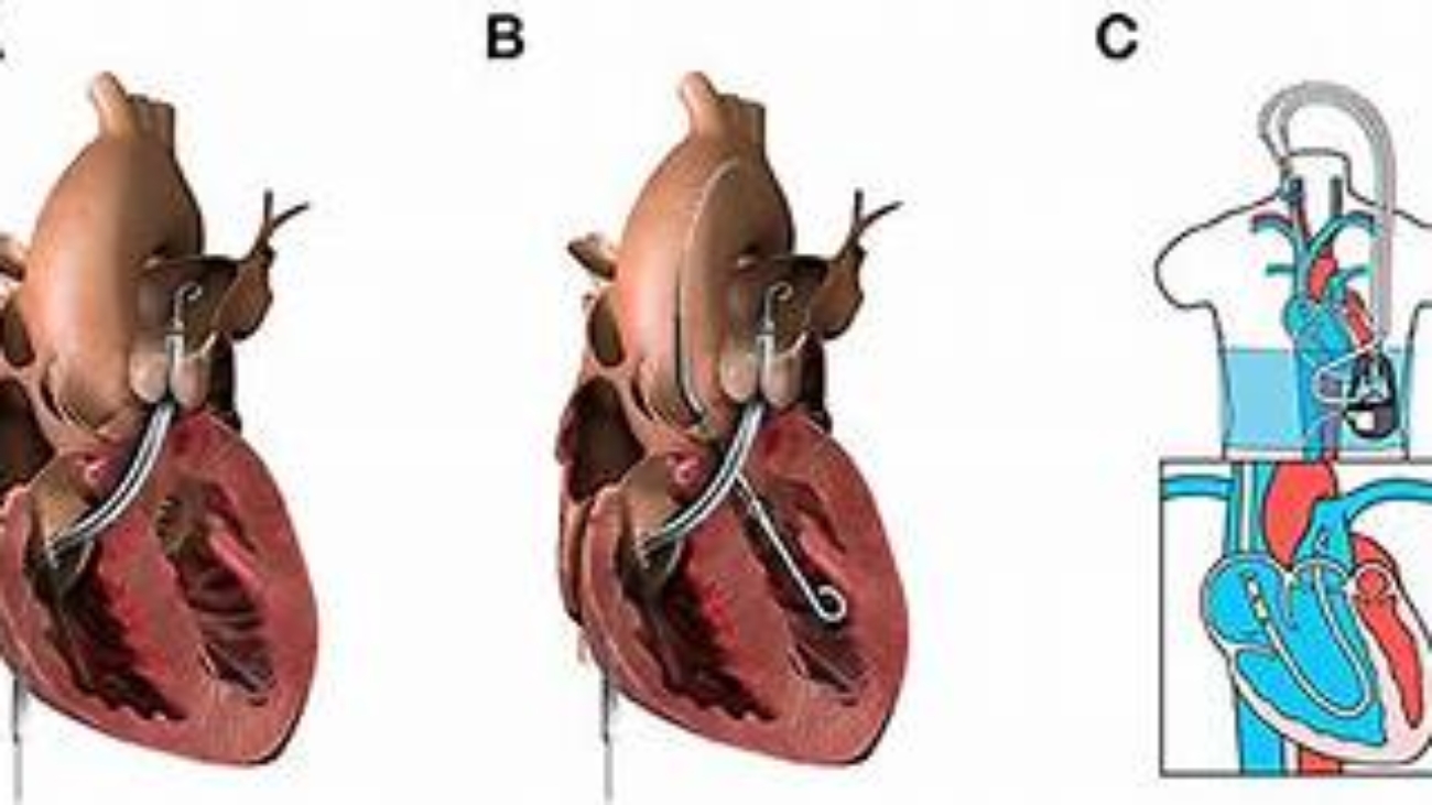 Mechanical Circulatory Support