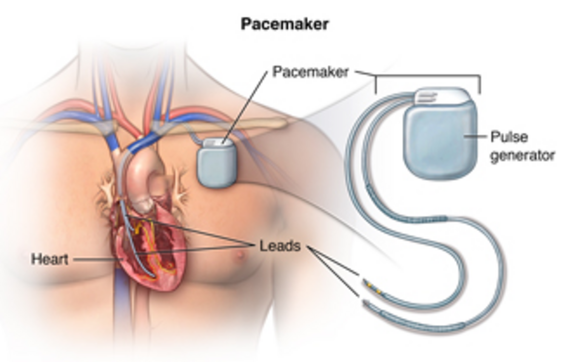 cardiac pacemaker specialist Dr. Kiran Lakkireddy