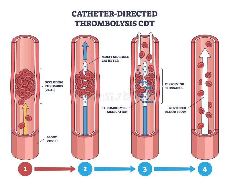 Catheter-directed thrombolysis specialist Dr.Kiran Lakkireddy