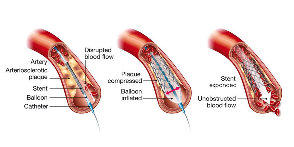 Coronary Angioplasty Stenting