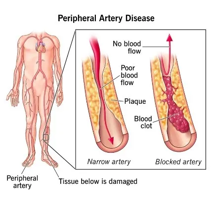 Peripheral Artery Disease Treatment | Dr. Kiran Lakkireddy