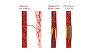 peripheral artery Stenting