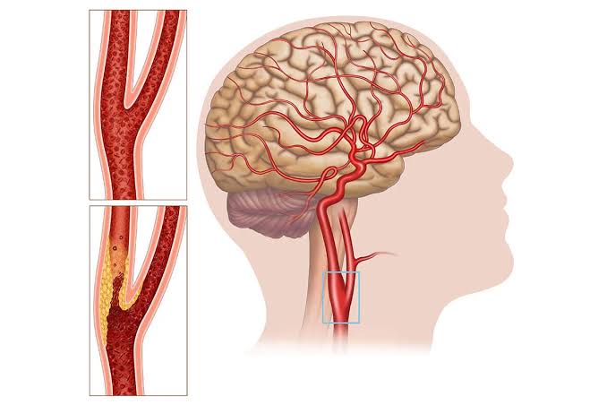 Carotid & Cerebral Angiogram