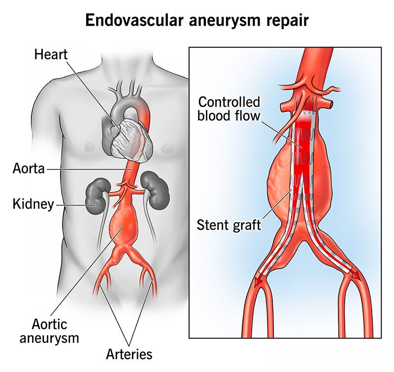 Endovascular Aortic Repair (EVAR)