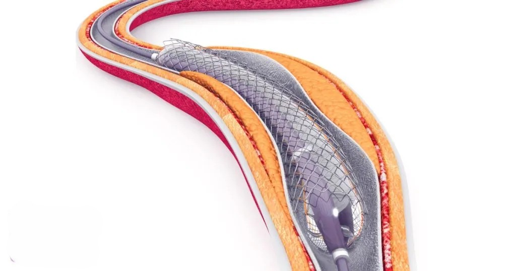 Peripheral Angiogram