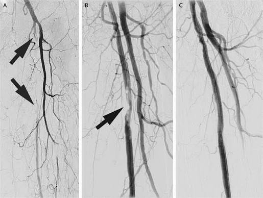 ACUTE LOWER AND LIMB ISCHEMIA