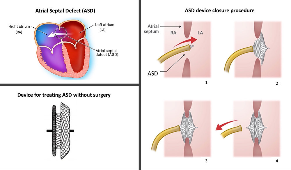 ASD AND DEVICE CLOSURE - Dr Kiran Lakkireddy Cardiologist Hyderabad