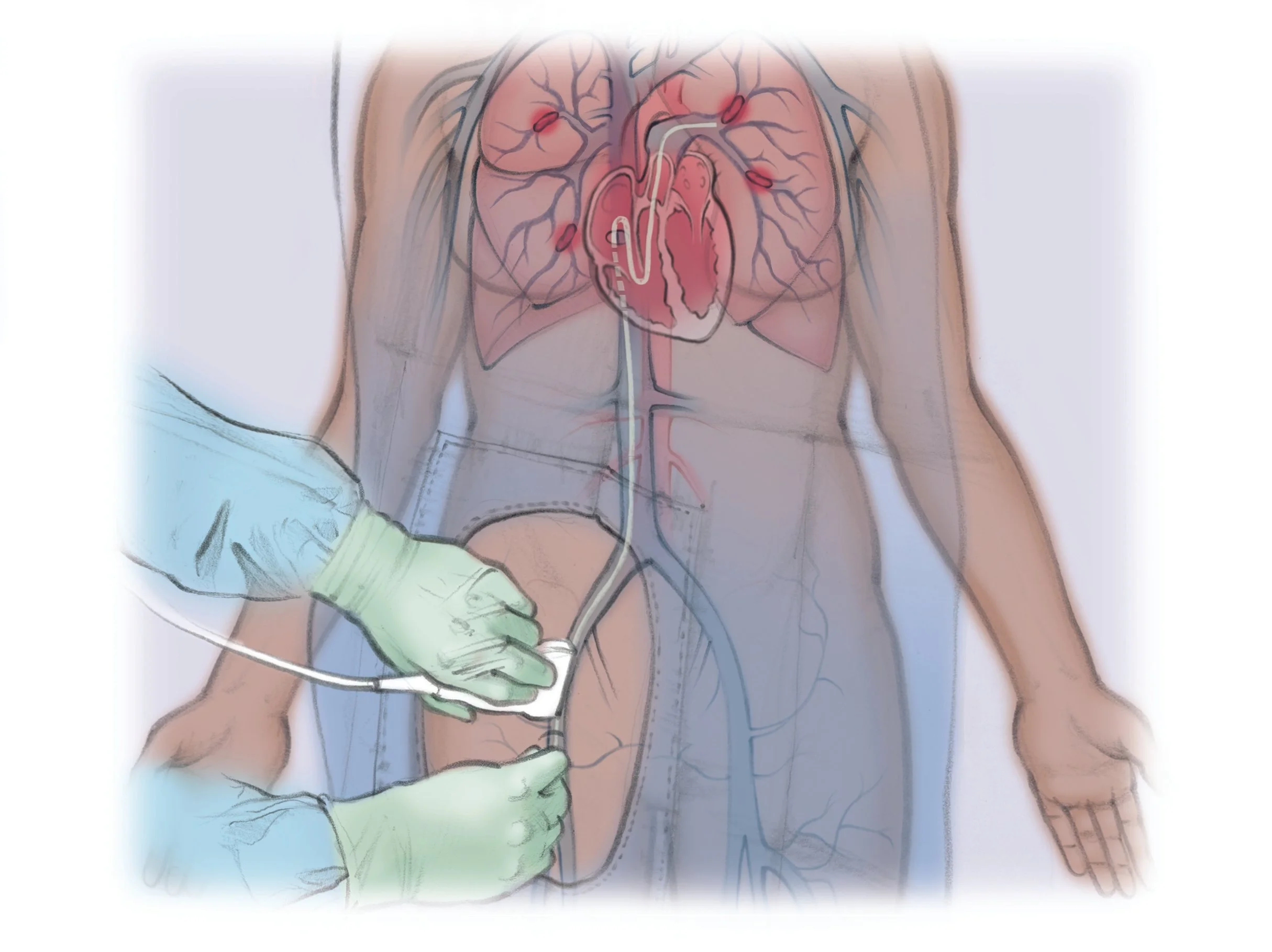 ASPIRATION THROMBECTOMY IN PULMONARY EMBOLISM & ACUTE PERIPHERAL VESSEL THROMBOTIC OCCLUSION - Dr Kiran Lakkireddy Cardiologist Hyderabad