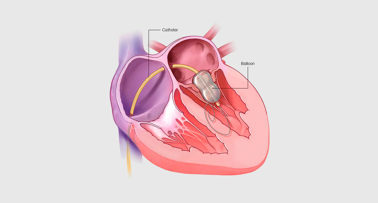 BALLOON VALVOTOMY - Dr Kiran Lakkireddy Cardiologist Hyderabad