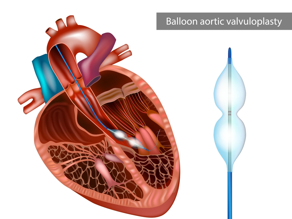 BAV – BALLOON AORTIC VALVOTOMY THEN - Dr Kiran Lakkireddy Cardiologist Hyderabad
