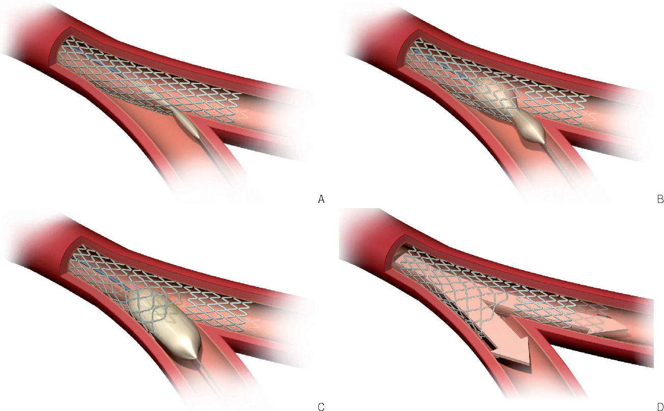 BIFURCATION STENTING | Dr Kiran Lakkireddy Cardiologist