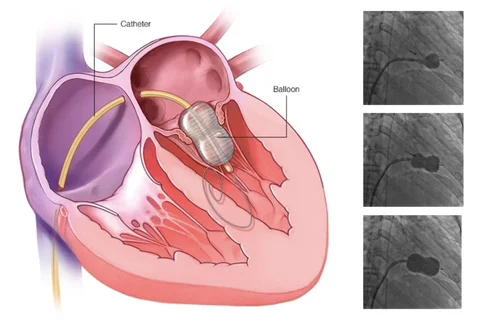 Balloon Mitral Valvotomy - Dr Kiran Lakkireddy Cardiologist Hyderabad
