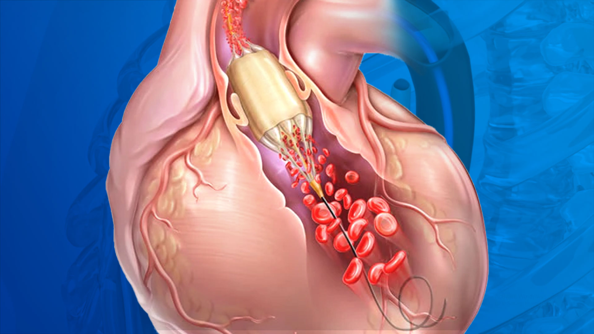 BPV – BALLOON AND PULMONARY VALVOTOMY - Dr Kiran Lakkireddy Cardiologist Hyderabad