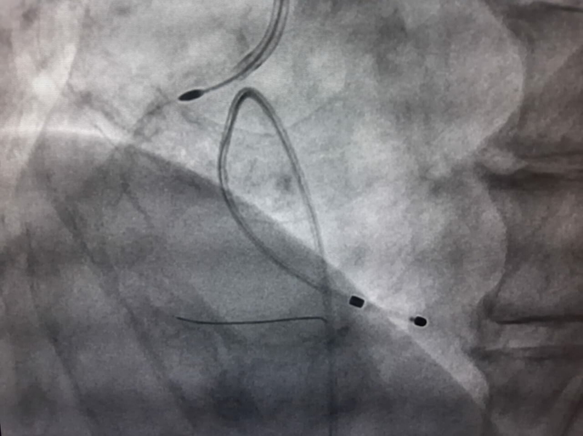 CHIP – COMPLEX and HIGH RISK CORONARY INTERVENTION - Dr Kiran Lakkireddy Cardiologist Hyderabad