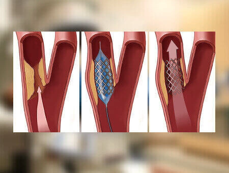 CHRONIC TOTAL OCCLUSION (CTO) STENTING | - Dr Kiran Lakkireddy Cardiologist Hyderabad