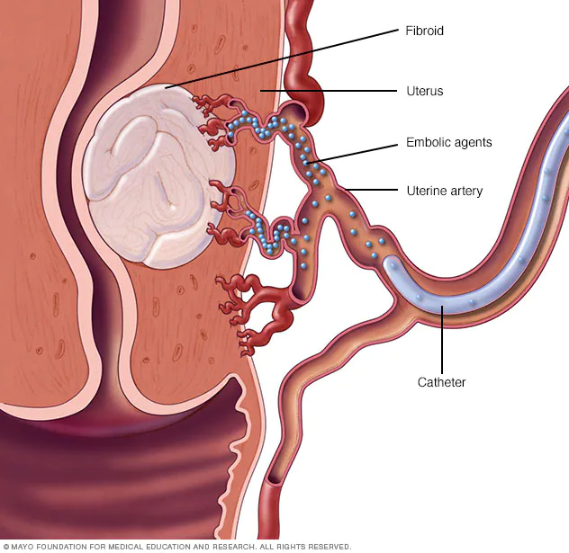 COIL CLOSURE / GEL FOAM CLOSURE FOR UTERINE ARTERY BLEEDING / BRONCHIAL BLEEDING