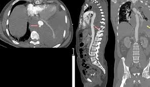 CT Aortogram and Peripheral Angiogram in Hyderabad