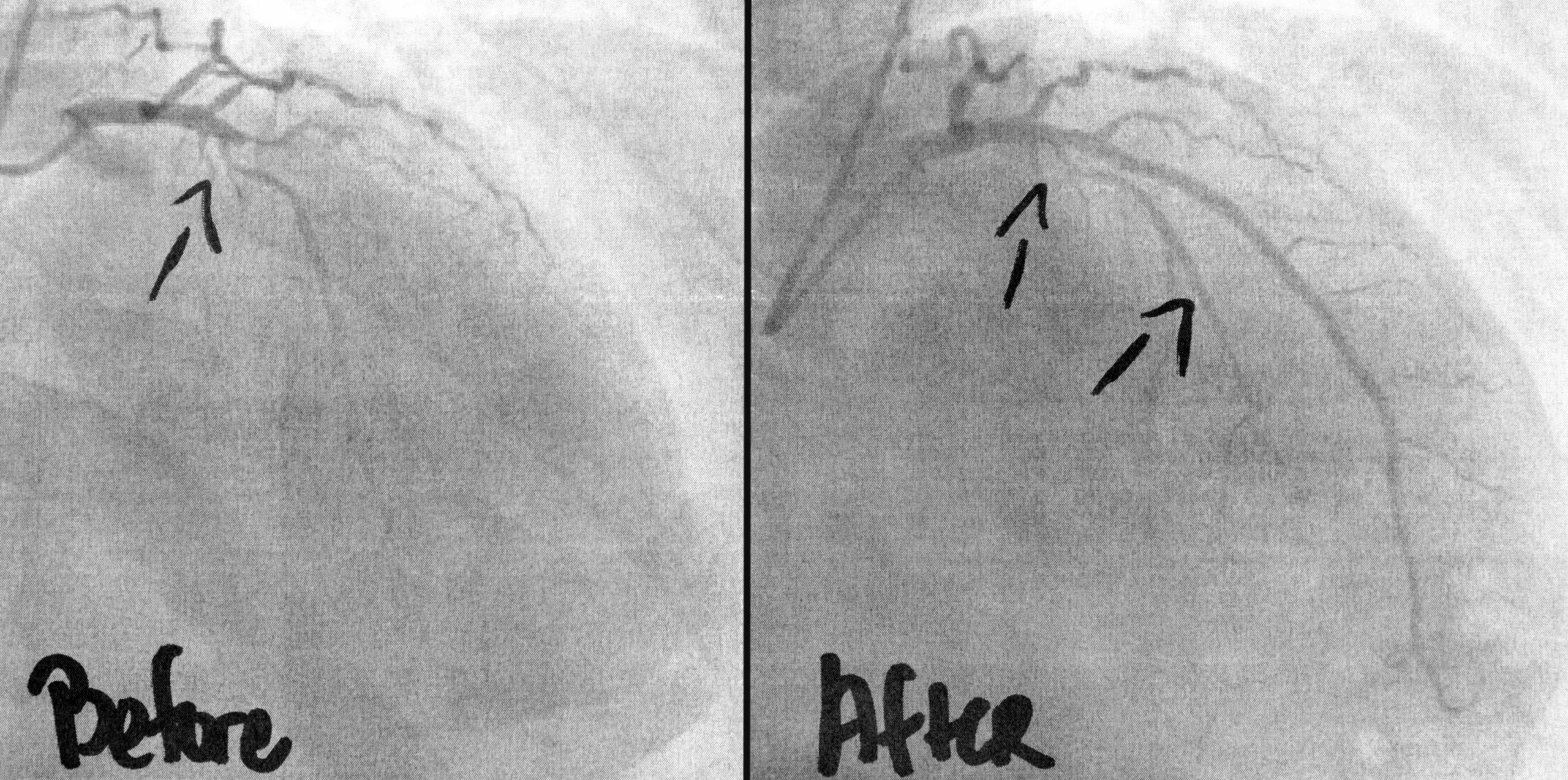 CT Coronary Angiogram in Hyderabad