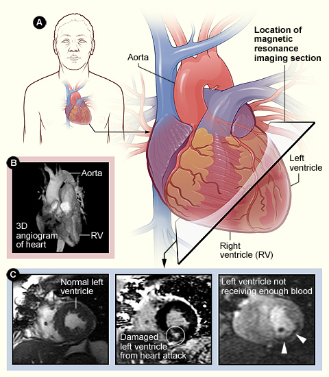 Cardiac MRI in Hyderabad