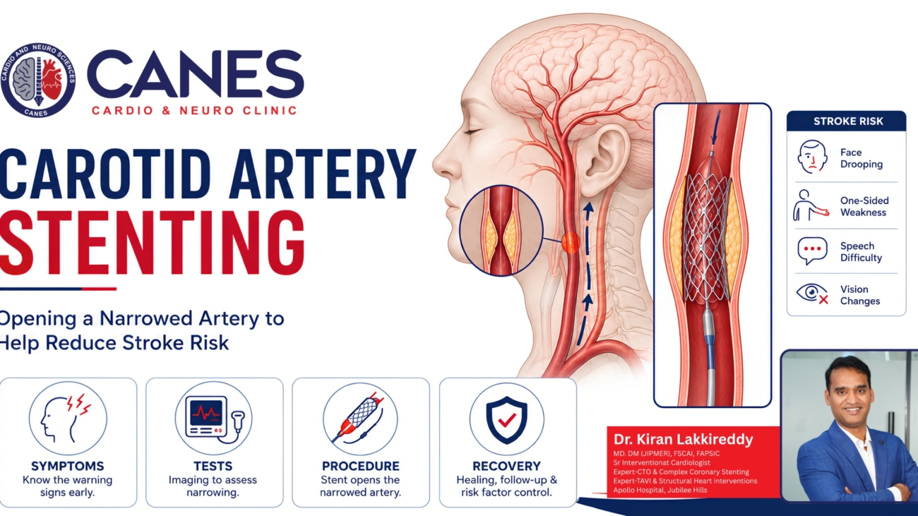 Carotid Artery Stenting: Your Complete Stroke Prevention Guide