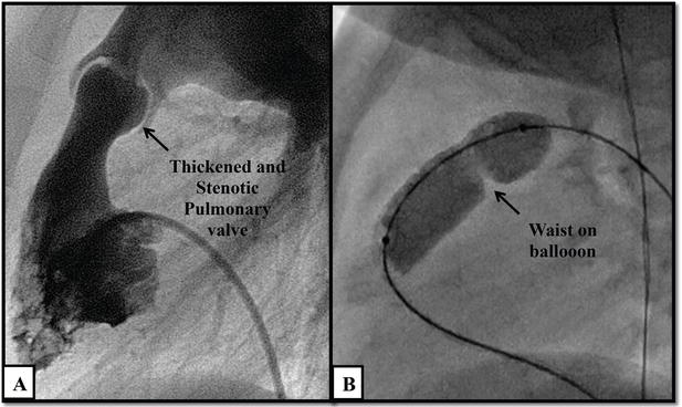 Cath Study Congenital Heart Disease
