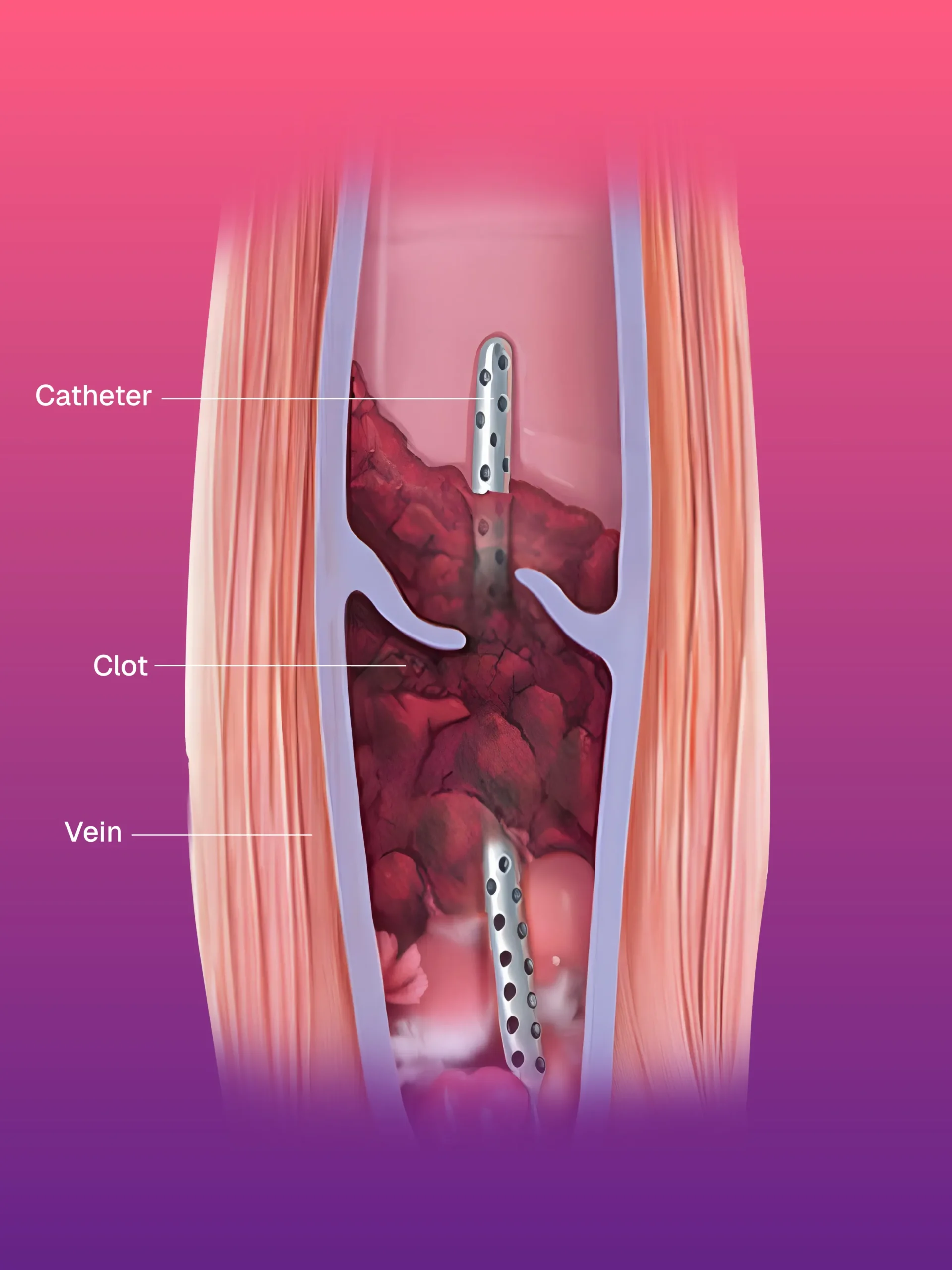 Catheter Directed Thrombolysis