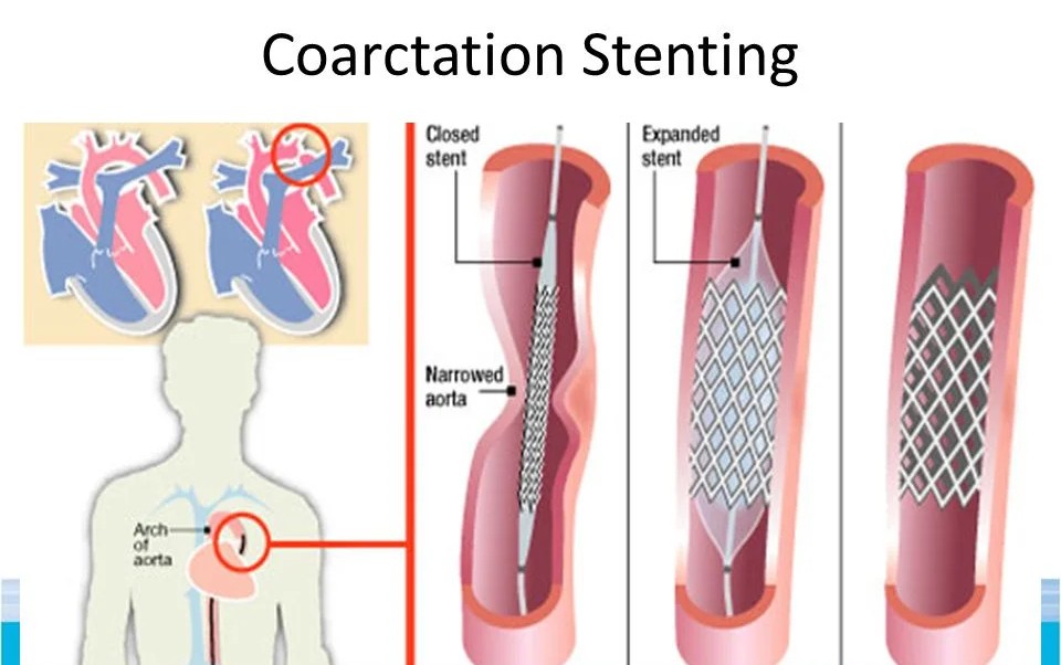 Coarctation of Aorta Stenting