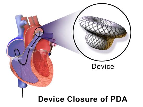 PDA DEVICE CLOSURE - Dr Kiran Lakkireddy Cardiologist Hyderabad