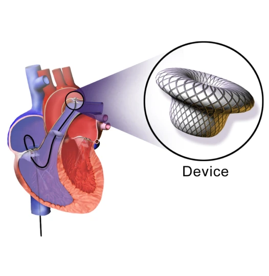 DEVICE CLOSURE OF ACYANOTIC CONGENITAL HEART DISEASE - Dr Kiran Lakkireddy Cardiologist Hyderabad