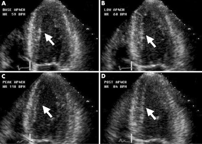 Dobutamine Stress Echocardiography DSE test in Hyderabad