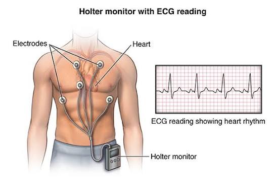 Holter Monitoring test in Hyderabad