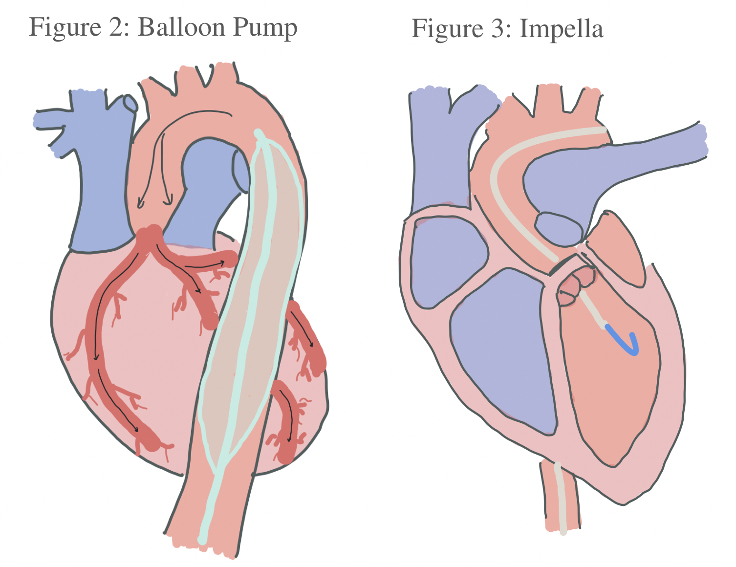 IABP and IMPELLA – FOR AN CARDIOGENIC SHOCK - Dr Kiran Lakkireddy Cardiologist Hyderabad