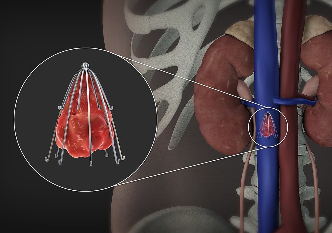 IVC FILTER - Dr Kiran Lakkireddy Cardiologist Hyderabad