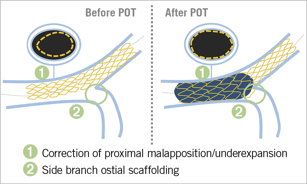 LEFT MAIN STENTING - Dr Kiran Lakkireddy Cardiologist Hyderabad