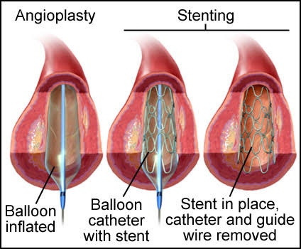 MESENTERIC AND ARTERY STENTING - Dr Kiran Lakkireddy Cardiologist Hyderabad
