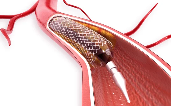 PRIMARY ANGIOPLASTY & THROMBOSUCTION | - Dr Kiran Lakkireddy Cardiologist Hyderabad