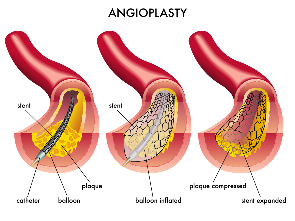 Peripheral Balloon and Angioplasty - Dr Kiran Lakkireddy Cardiologist Hyderabad