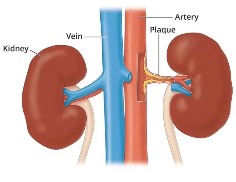 RENAL ARTERY STENTING - - Dr Kiran Lakkireddy Cardiologist Hyderabad