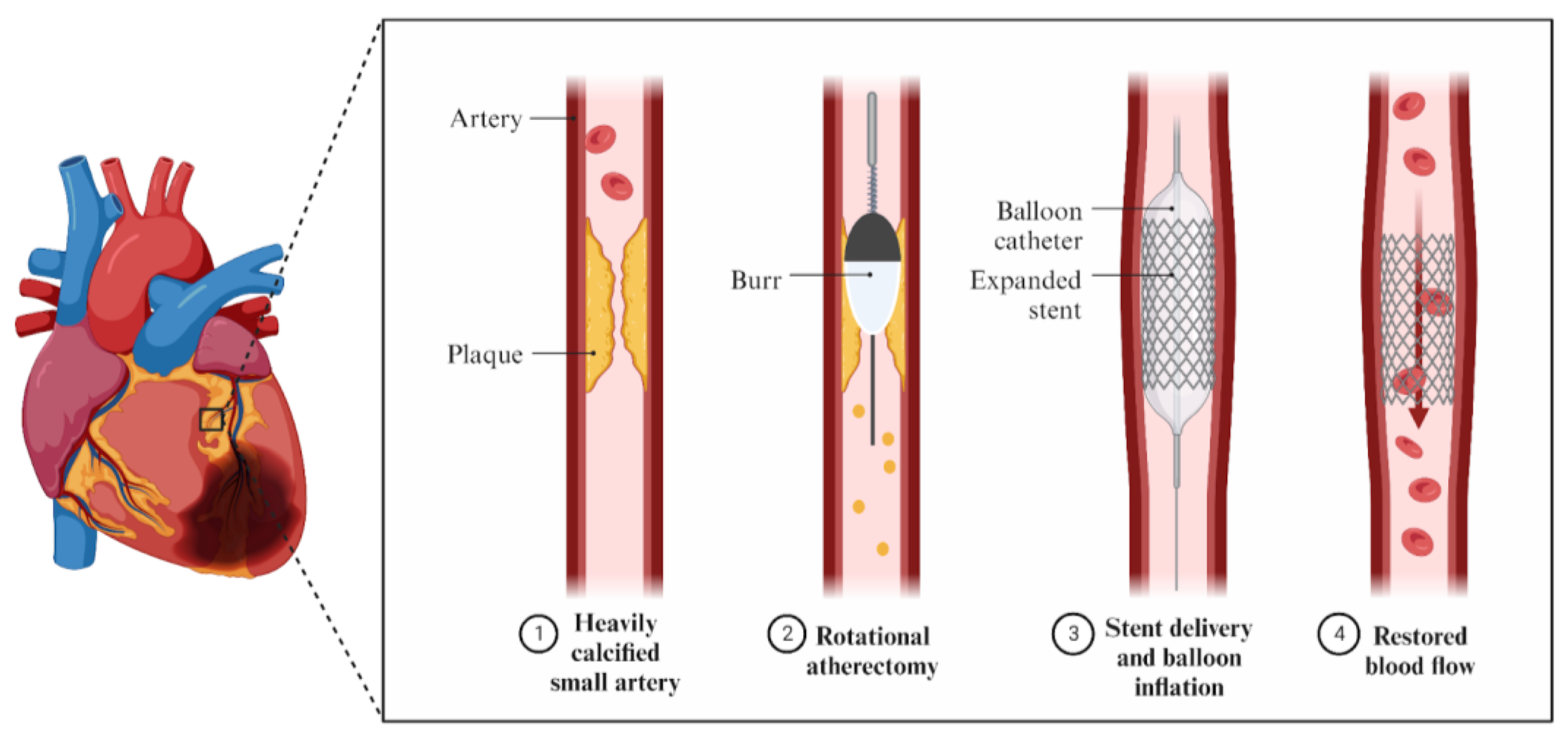 Rotablation, Orbital and Atherectomy, or Intravascular Lithotripsy for Calcific Lesion - Dr Kiran Lakkireddy Cardiologist Hyderabad