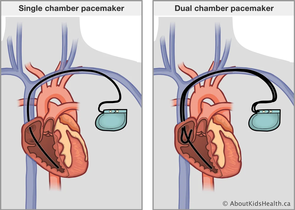 SINGLE AND DUAL CHAMBER PACEMAKER - Dr Kiran Lakkireddy Cardiologist Hyderabad