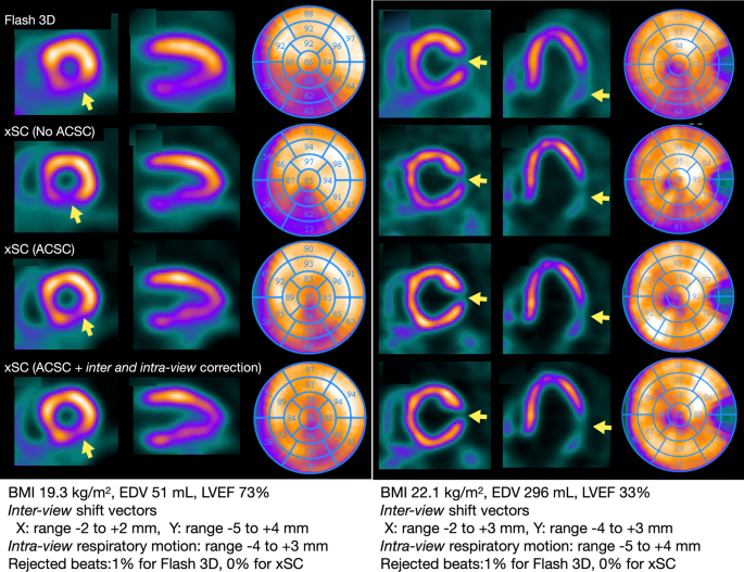 SPECT Myocardial Perfusion Imaging and Viability Test in Hyderabad