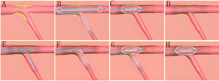 SIMPLE LESION STENTING | Dr Kiran Lakkireddy Cardiologist