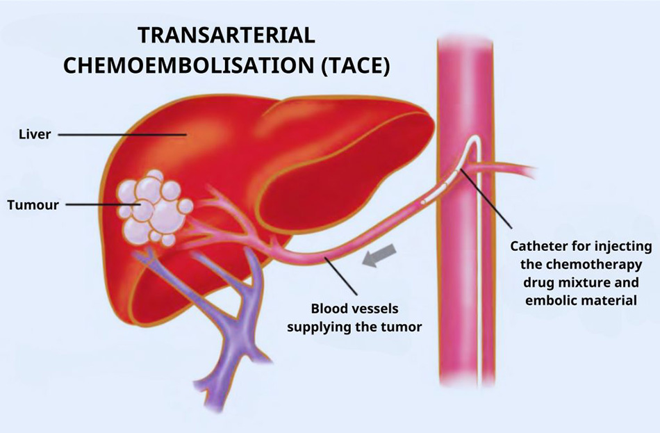 TACE – TRANSARTERIAL CHEMOEMBOLISATION