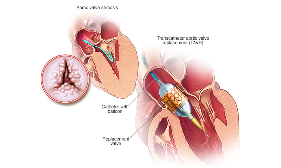 TAVI Procedure (TRANSCATHETER AORTIC VALVE IMPLANTATION)